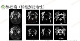 DWI序列判读原则及临床应用