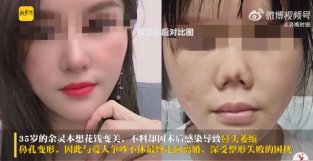 女子隆鼻失败后婚姻破裂，衣起诉整形医院