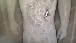 深圳3岁幼童吞下磁力珠后导致肠穿孔，医生：不及时就医恐危及生命