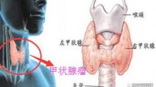 甲状腺专家赵萍：脖子发现这2种异常，要警惕