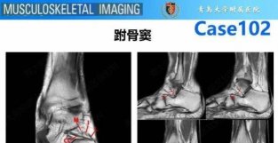 副比目鱼肌的影像表现