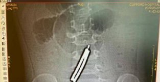 3岁女童误吞11块磁力棒，肠子磨穿5个洞