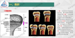 骨骺损伤及常见各类骨折的分型及诊断