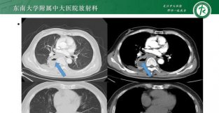 肺隔离症 影像表现