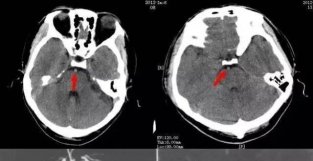 “脑血管高密度征”一定是梗塞吗？