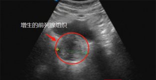 古稀老人受前列腺增生困扰多年 国内首例手术助他一身轻松