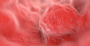 CD：HIV要物或成治疗肠癌的新贵？