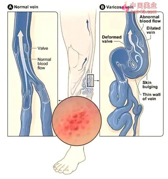 静脉曲张竟能把腿害成这样？千万别错过这个拯救皮肤的最后机会