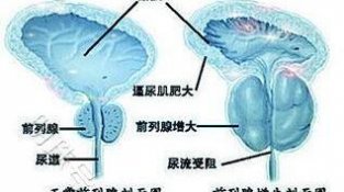 北京嘉佩乐医院主任浅谈慢新前列腺炎