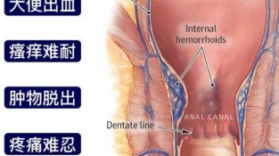 长痔疮了怎么办？八招教你预防跟治疗痔疮
