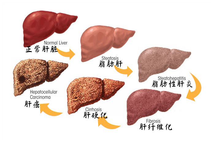 吃什么才护肝？美国肝脏基金会这样说