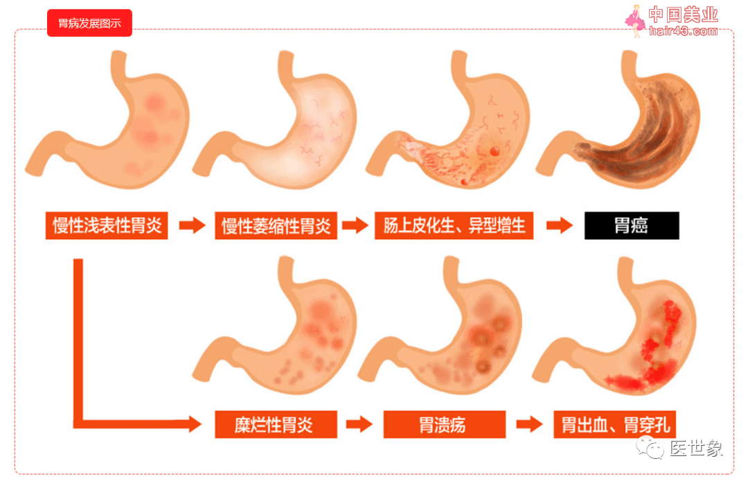 国际公认的1类致癌物：幽门螺旋杆菌，哪些感染者可能发展成胃癌？