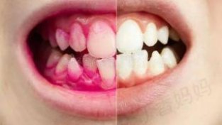清洁孩子的牙齿，4 个护理方法家长一定要知道