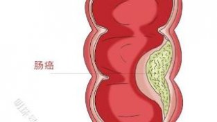 4种肠癌早期症状，45岁以上尤其注意