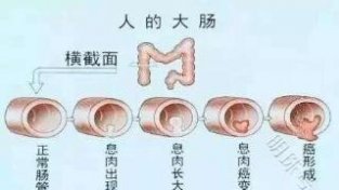 这4类人，是肠息肉的高发人群，请定期做好检查，莫大意